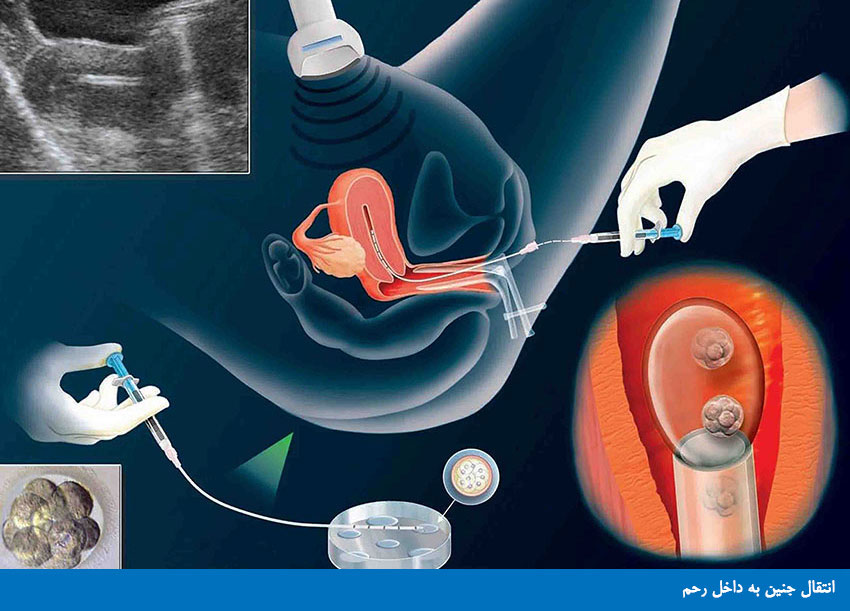 دستورات دارویی بعد از عمل تخمك كشی opu